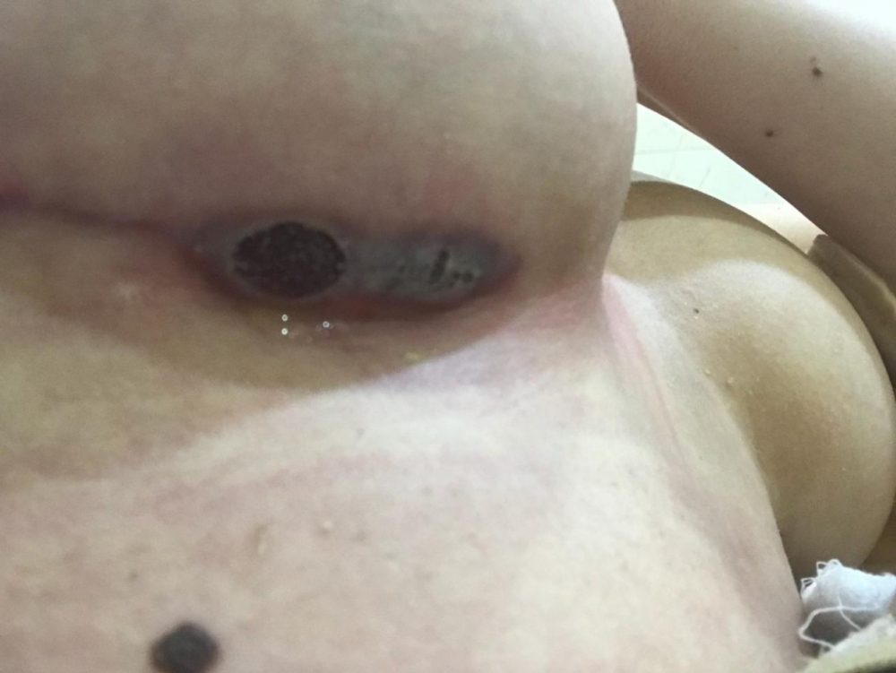 Девушка лишилась груди после ее увеличения до 3 размера в клинике «Эстетическая хирургия», - «Блокнот Волгограда»