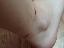 Камышанин выложил в соцсетях свои раны после нападения бродячих собак