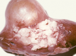 Пациенту хирурги удалили почку, в которой поселились личинки огромных червей