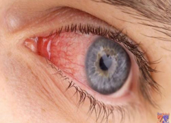 Камышанка запустила в брата бутылку с уксусом и сожгла ему роговицу