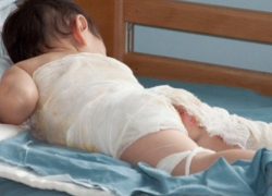 В хирургию Камышинской детской больницы доставлен 10-месячный мальчик, обварившийся кипятком