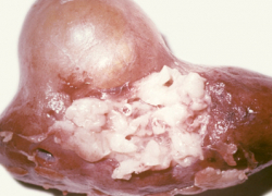 Пациенту хирурги удалили почку, в которой поселились личинки огромных червей