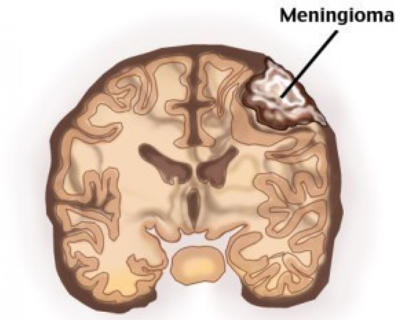 Особенности лечения менингиомы в Израиле